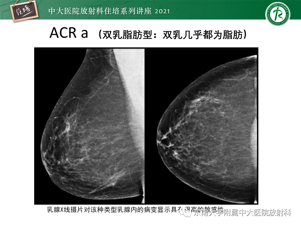 影像PPT - 【PPT】DBT相较于FFDM对于不同X线表现类型乳腺病变的诊断价值-7