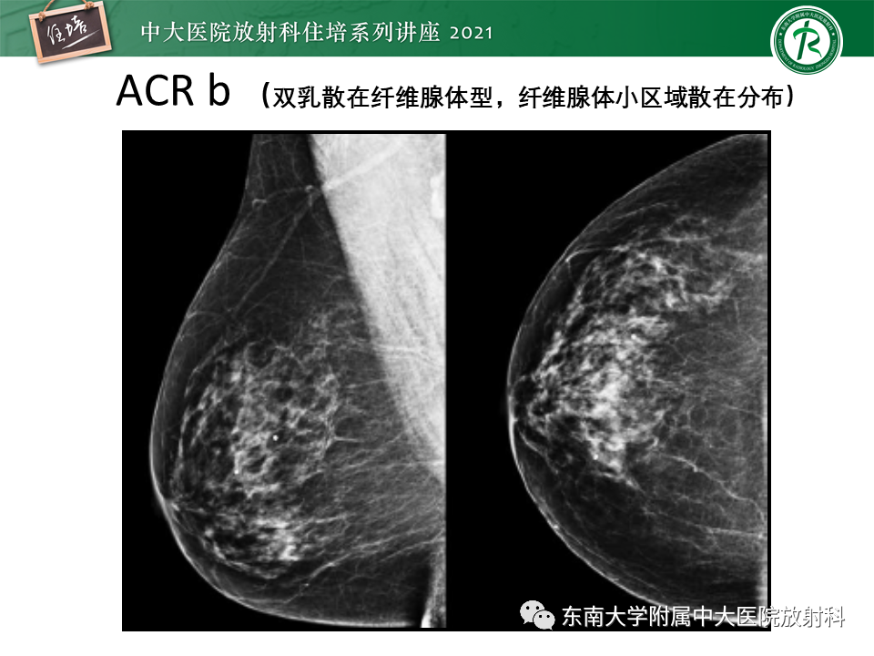 影像PPT - 【PPT】DBT相较于FFDM对于不同X线表现类型乳腺病变的诊断价值-8
