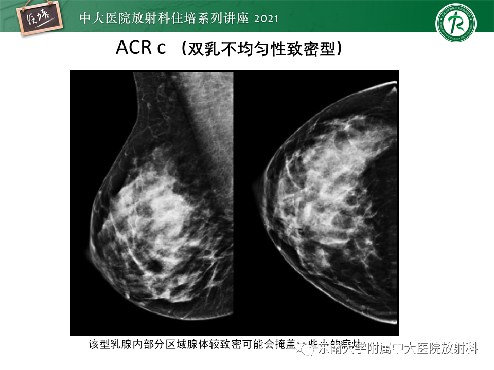 影像PPT - 【PPT】DBT相较于FFDM对于不同X线表现类型乳腺病变的诊断价值-9
