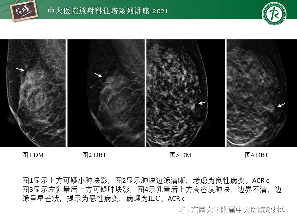 影像PPT - 【PPT】DBT相较于FFDM对于不同X线表现类型乳腺病变的诊断价值-12