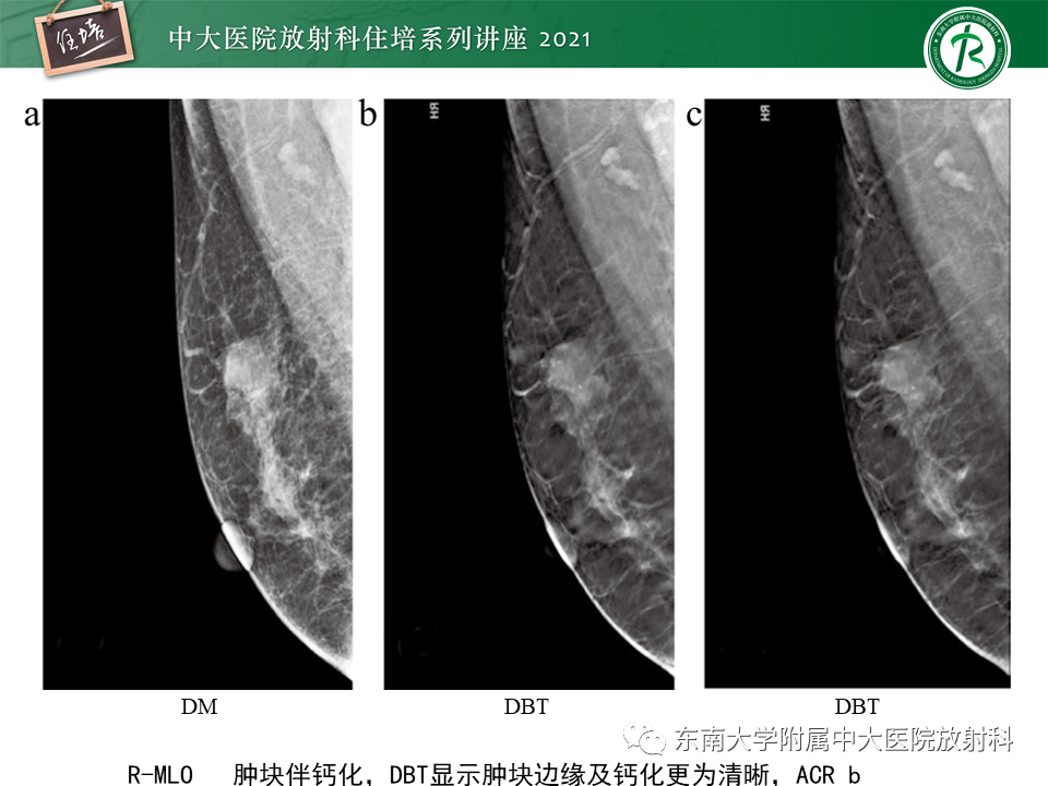 影像PPT - 【PPT】DBT相较于FFDM对于不同X线表现类型乳腺病变的诊断价值-13
