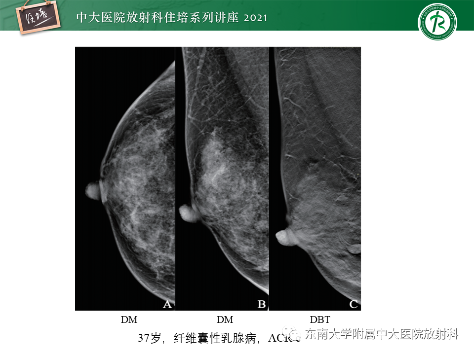 影像PPT - 【PPT】DBT相较于FFDM对于不同X线表现类型乳腺病变的诊断价值-14