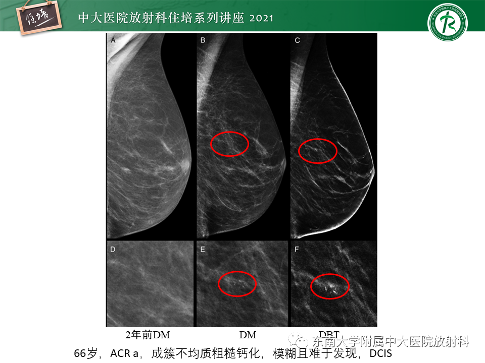 影像PPT - 【PPT】DBT相较于FFDM对于不同X线表现类型乳腺病变的诊断价值-16