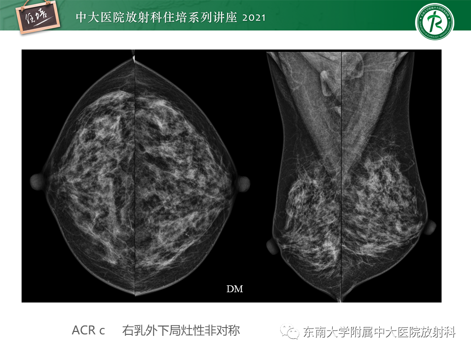 影像PPT - 【PPT】DBT相较于FFDM对于不同X线表现类型乳腺病变的诊断价值-17