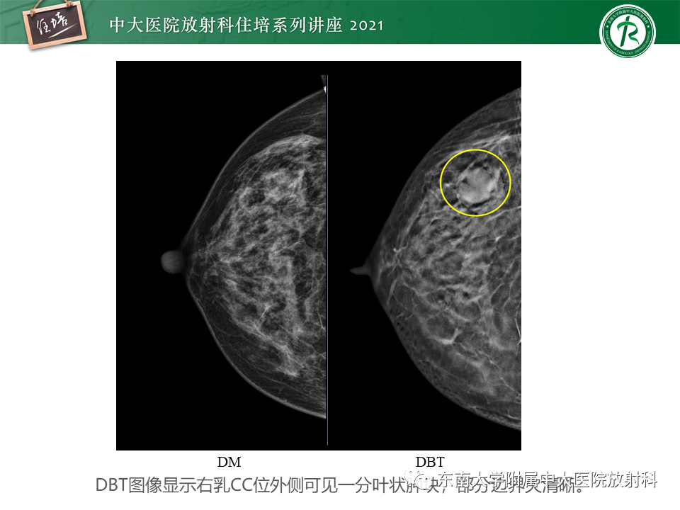 影像PPT - 【PPT】DBT相较于FFDM对于不同X线表现类型乳腺病变的诊断价值-18