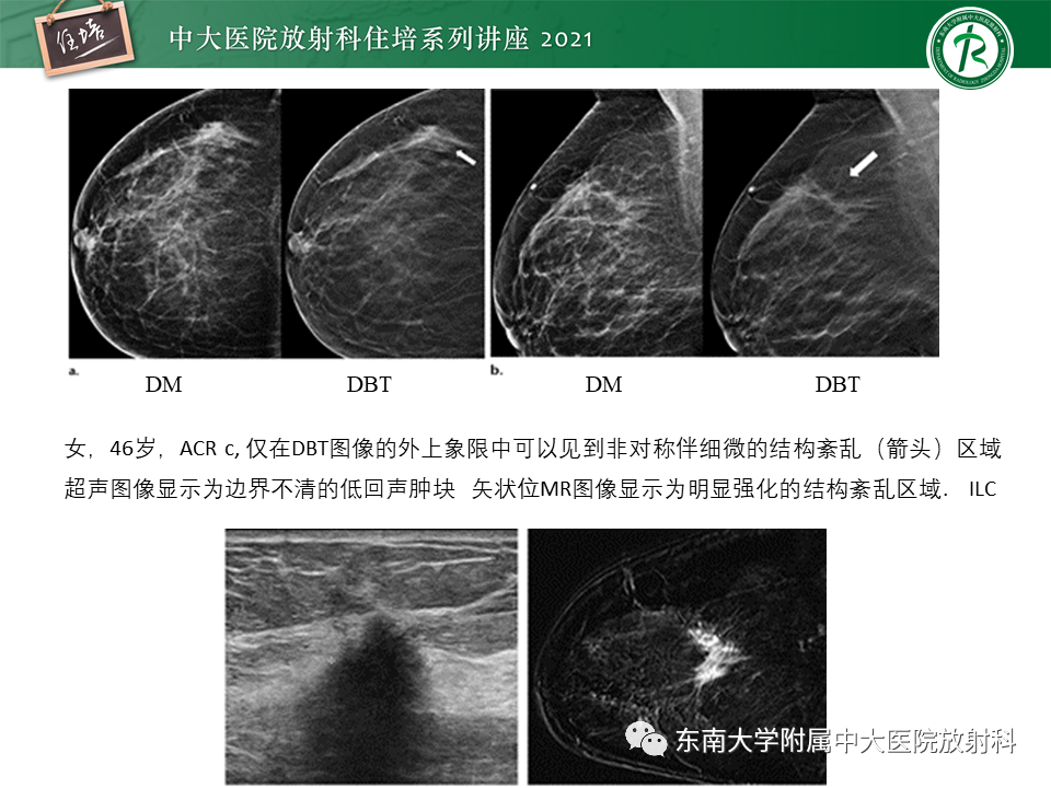 影像PPT - 【PPT】DBT相较于FFDM对于不同X线表现类型乳腺病变的诊断价值-19