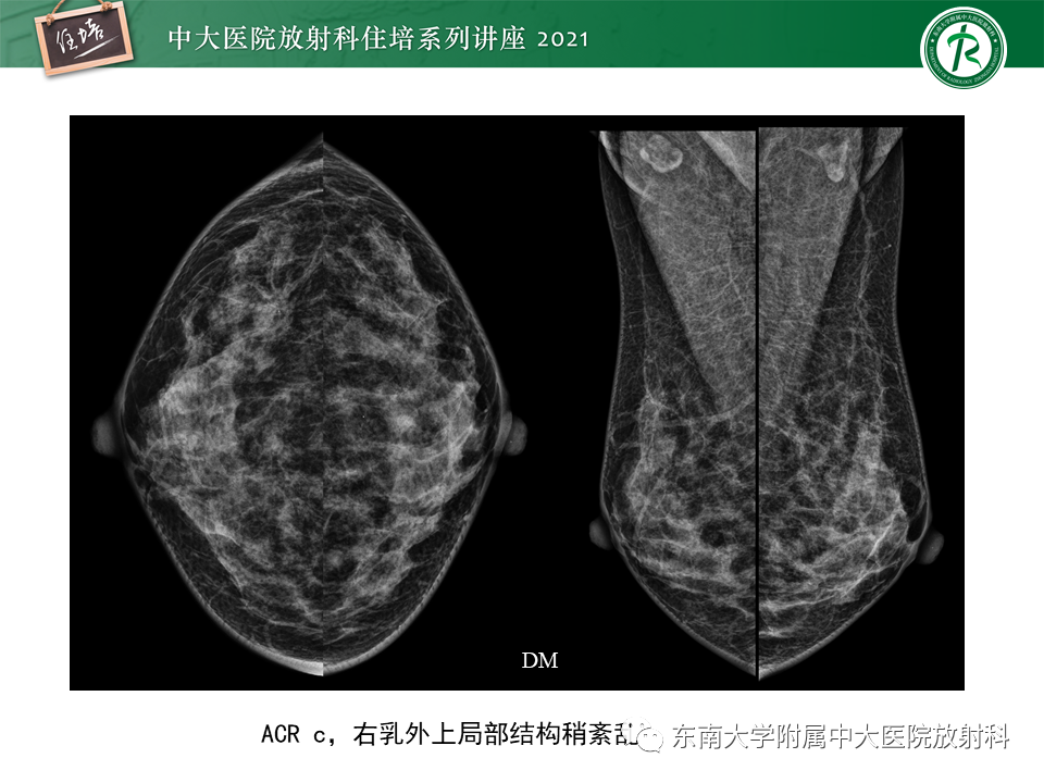 影像PPT - 【PPT】DBT相较于FFDM对于不同X线表现类型乳腺病变的诊断价值-20