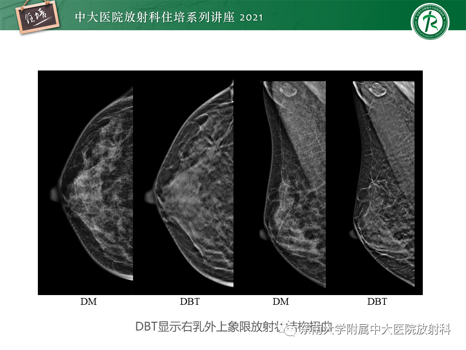 影像PPT - 【PPT】DBT相较于FFDM对于不同X线表现类型乳腺病变的诊断价值-21
