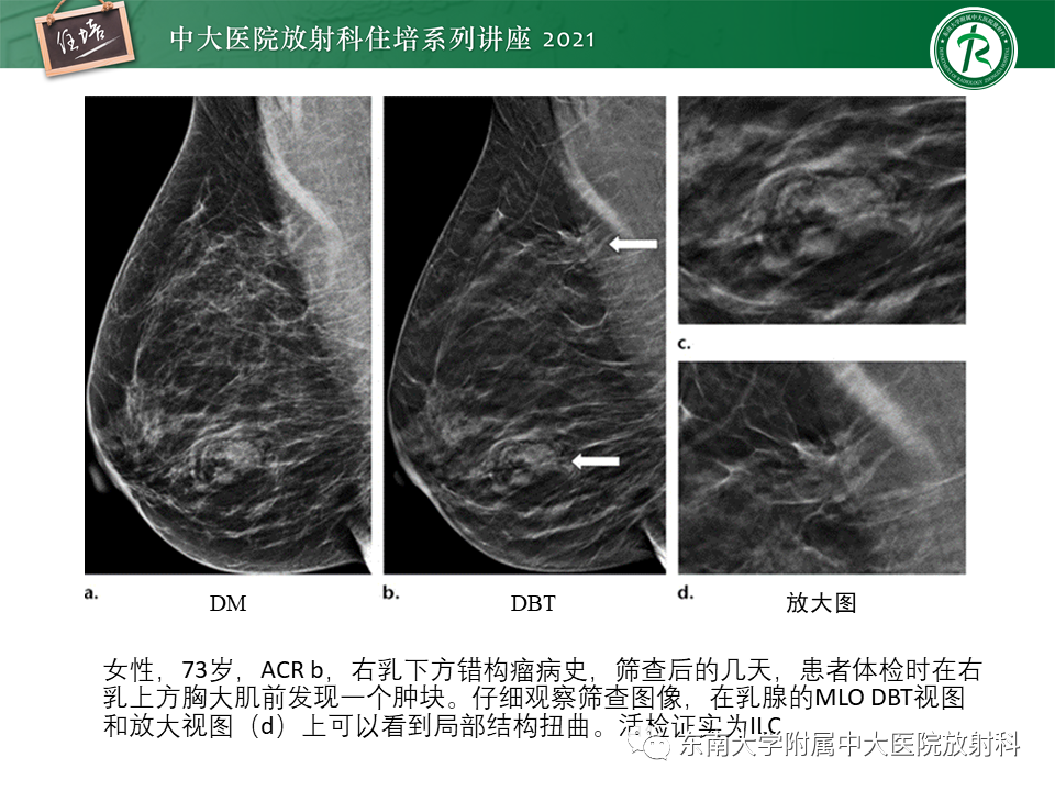 影像PPT - 【PPT】DBT相较于FFDM对于不同X线表现类型乳腺病变的诊断价值-22