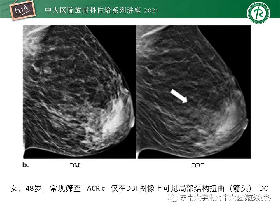 影像PPT - 【PPT】DBT相较于FFDM对于不同X线表现类型乳腺病变的诊断价值-23