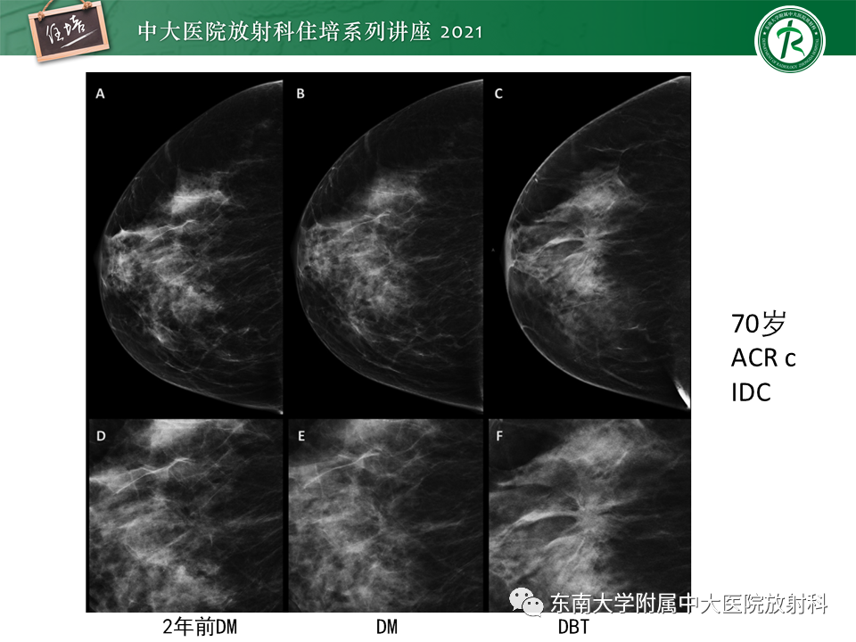 影像PPT - 【PPT】DBT相较于FFDM对于不同X线表现类型乳腺病变的诊断价值-24