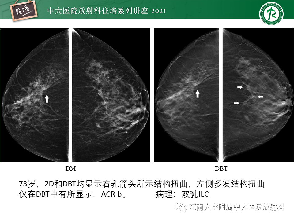 影像PPT - 【PPT】DBT相较于FFDM对于不同X线表现类型乳腺病变的诊断价值-25
