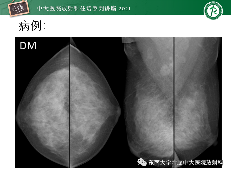 影像PPT - 【PPT】DBT相较于FFDM对于不同X线表现类型乳腺病变的诊断价值-26