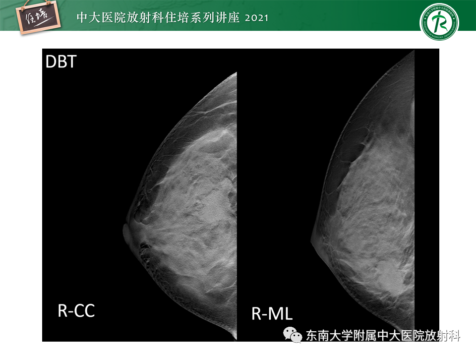 影像PPT - 【PPT】DBT相较于FFDM对于不同X线表现类型乳腺病变的诊断价值-28