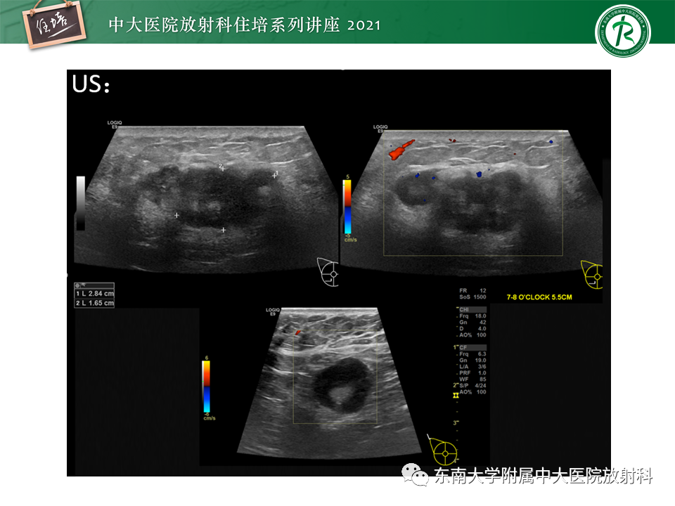 影像PPT - 【PPT】DBT相较于FFDM对于不同X线表现类型乳腺病变的诊断价值-29