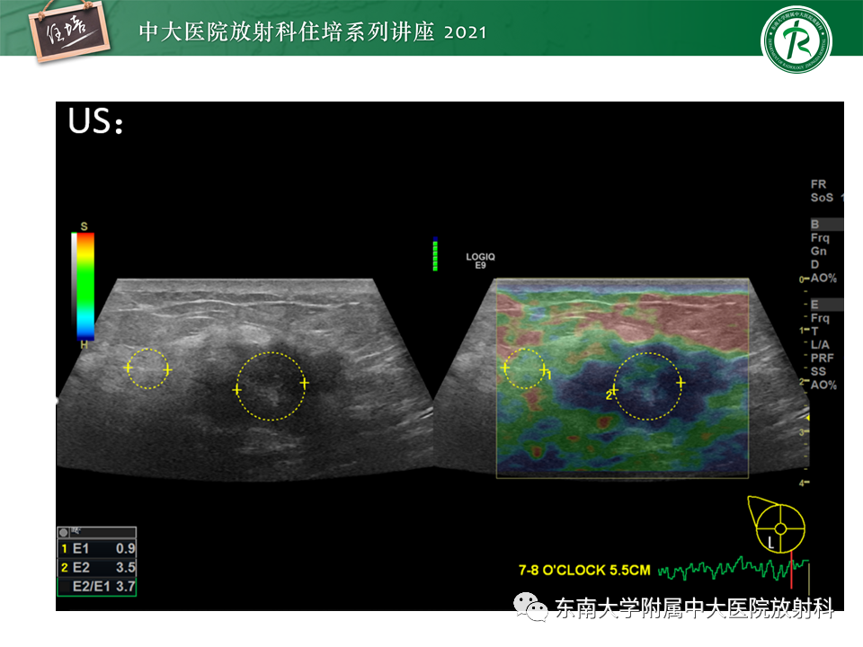 影像PPT - 【PPT】DBT相较于FFDM对于不同X线表现类型乳腺病变的诊断价值-30