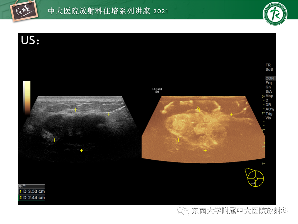 影像PPT - 【PPT】DBT相较于FFDM对于不同X线表现类型乳腺病变的诊断价值-31