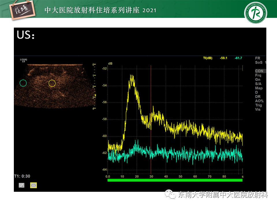 影像PPT - 【PPT】DBT相较于FFDM对于不同X线表现类型乳腺病变的诊断价值-32