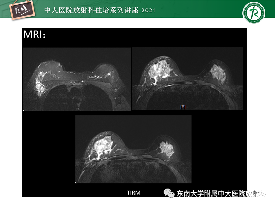 影像PPT - 【PPT】DBT相较于FFDM对于不同X线表现类型乳腺病变的诊断价值-33