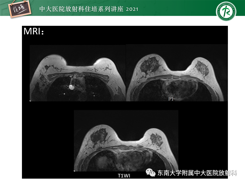 影像PPT - 【PPT】DBT相较于FFDM对于不同X线表现类型乳腺病变的诊断价值-34