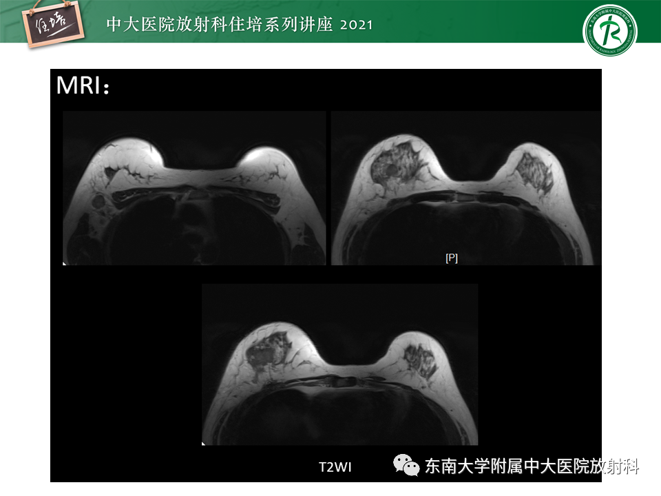 影像PPT - 【PPT】DBT相较于FFDM对于不同X线表现类型乳腺病变的诊断价值-35