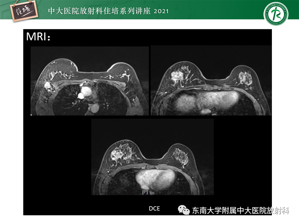 影像PPT - 【PPT】DBT相较于FFDM对于不同X线表现类型乳腺病变的诊断价值-36