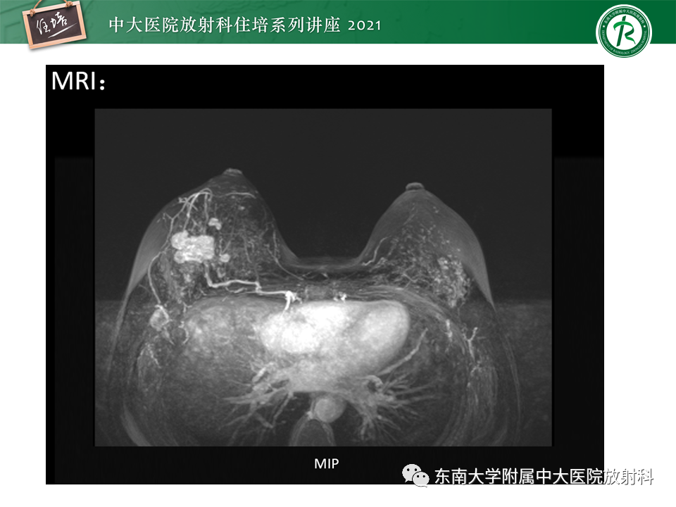 影像PPT - 【PPT】DBT相较于FFDM对于不同X线表现类型乳腺病变的诊断价值-37