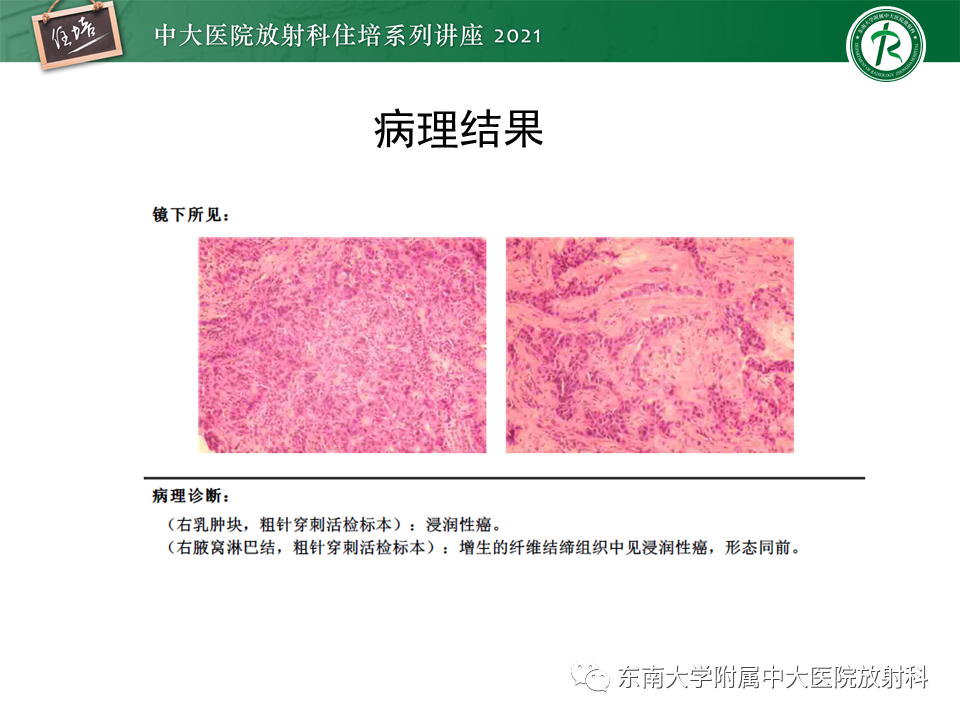 影像PPT - 【PPT】DBT相较于FFDM对于不同X线表现类型乳腺病变的诊断价值-38