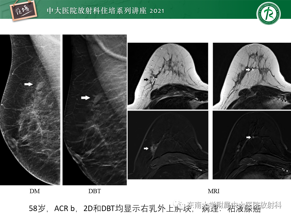 影像PPT - 【PPT】DBT相较于FFDM对于不同X线表现类型乳腺病变的诊断价值-40