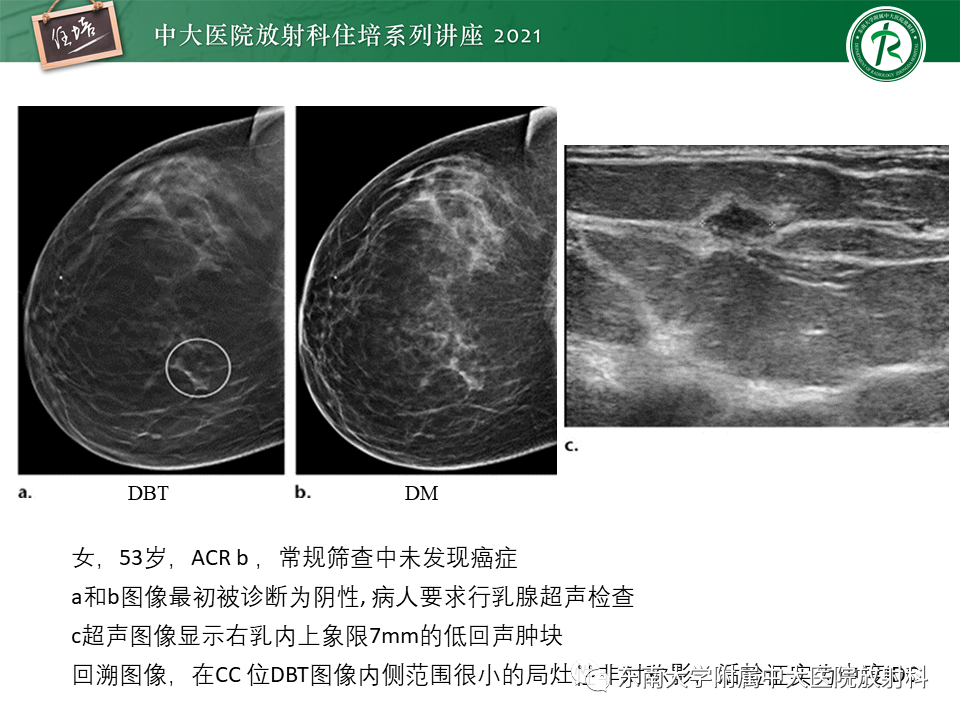 影像PPT - 【PPT】DBT相较于FFDM对于不同X线表现类型乳腺病变的诊断价值-41