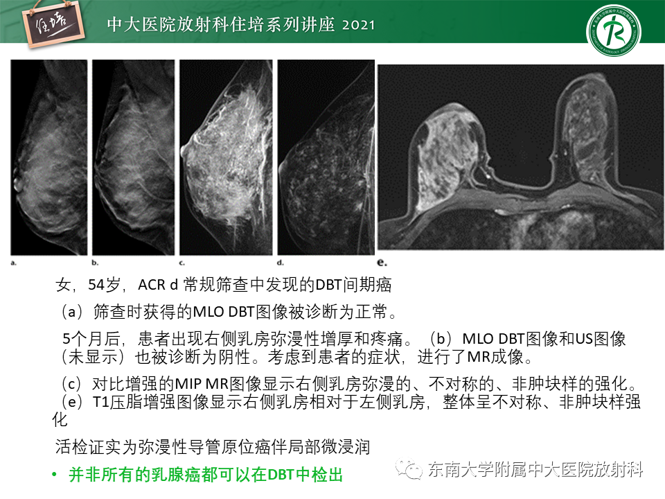 影像PPT - 【PPT】DBT相较于FFDM对于不同X线表现类型乳腺病变的诊断价值-42