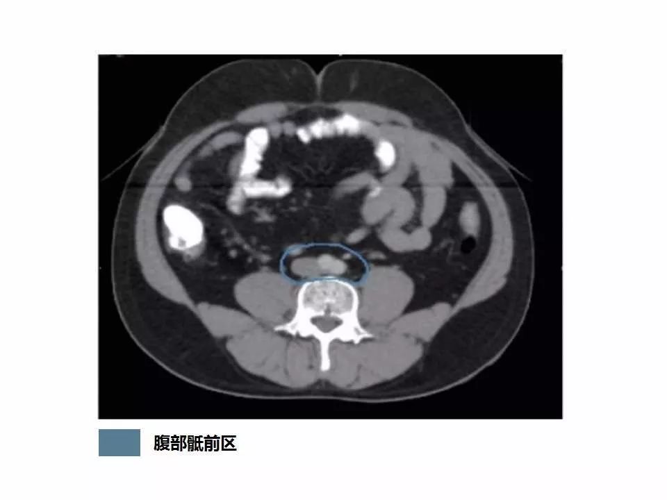 影像PPT - 直肠癌淋巴引流区图谱-2