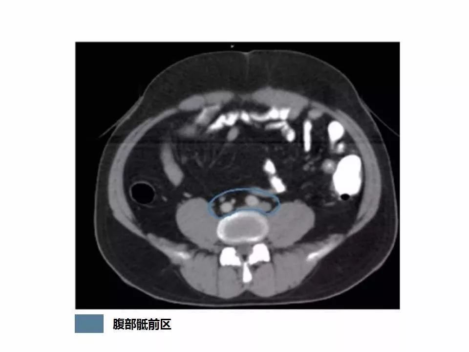 影像PPT - 直肠癌淋巴引流区图谱-5