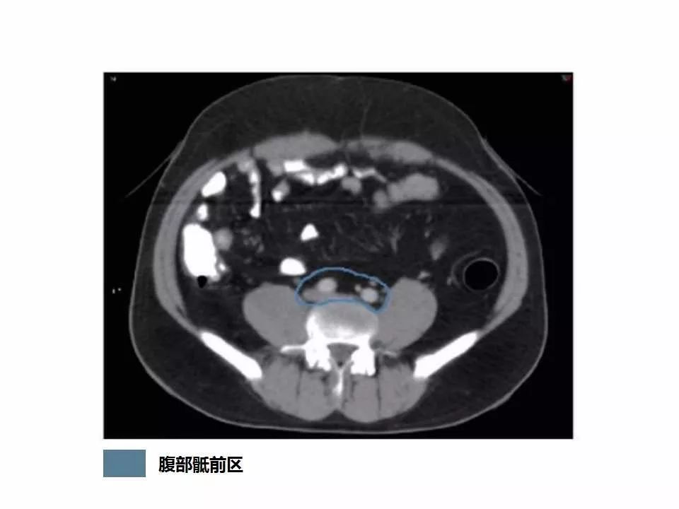 影像PPT - 直肠癌淋巴引流区图谱-6