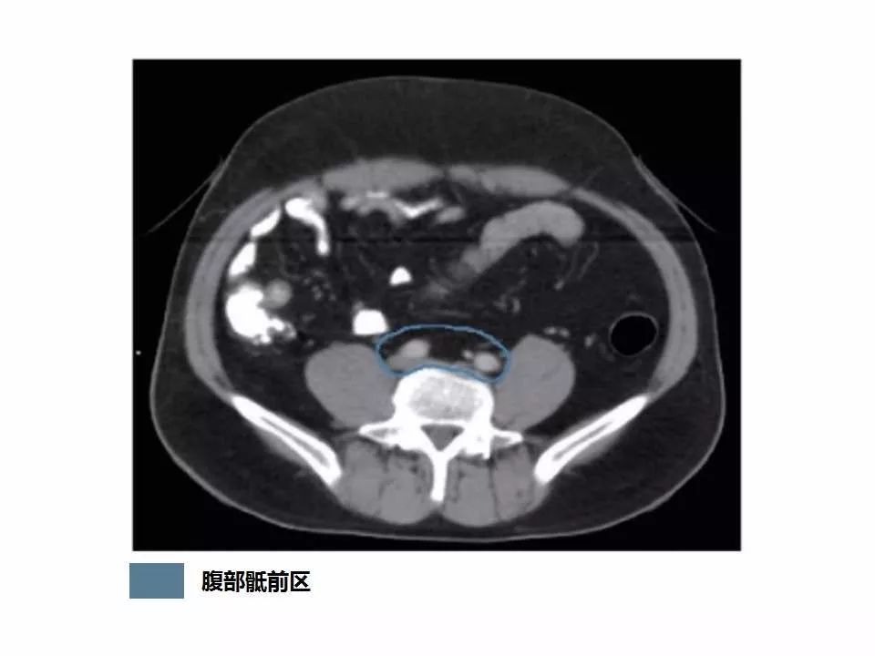 影像PPT - 直肠癌淋巴引流区图谱-7