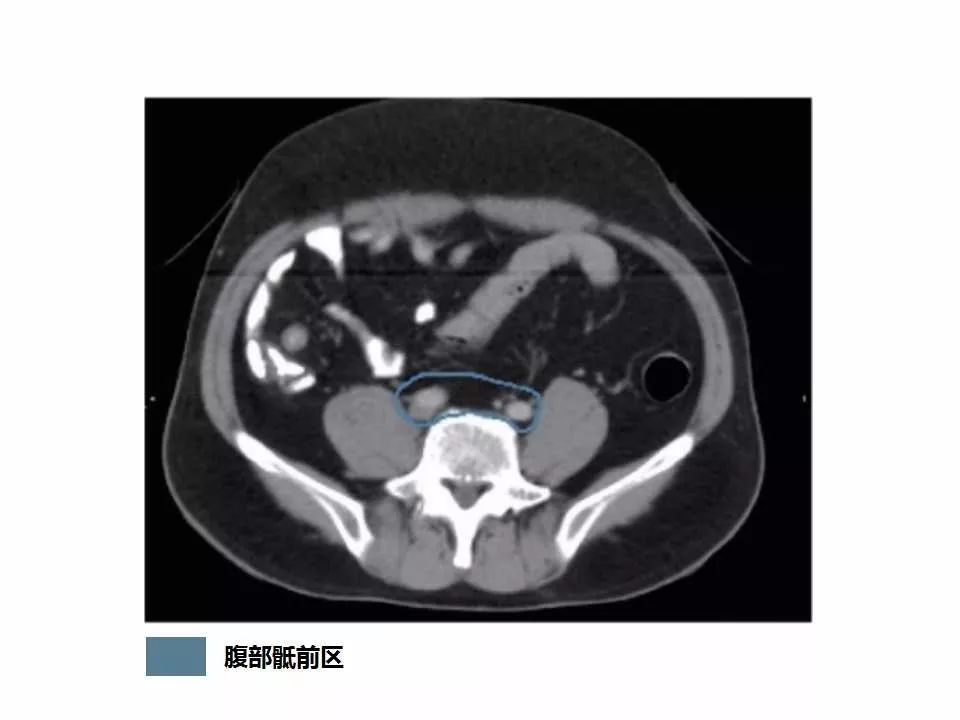影像PPT - 直肠癌淋巴引流区图谱-8