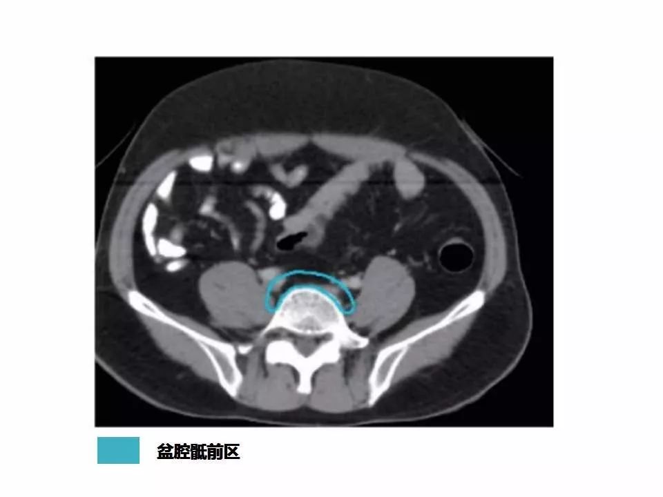 影像PPT - 直肠癌淋巴引流区图谱-9