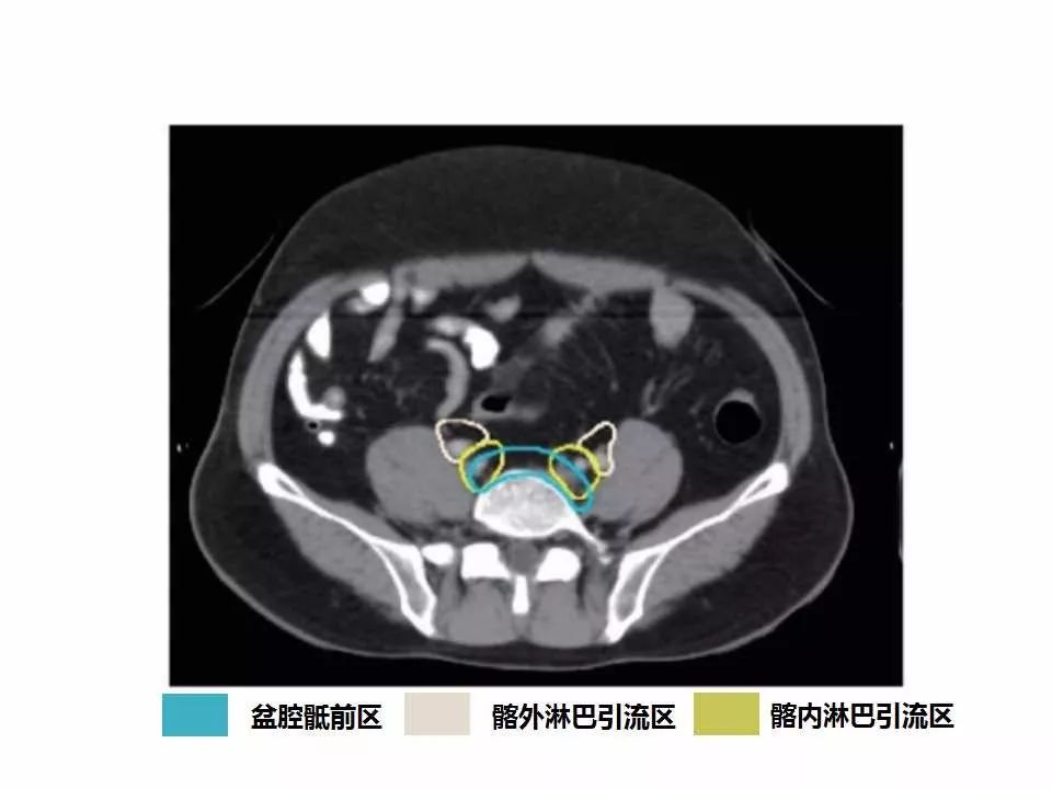 影像PPT - 直肠癌淋巴引流区图谱-10