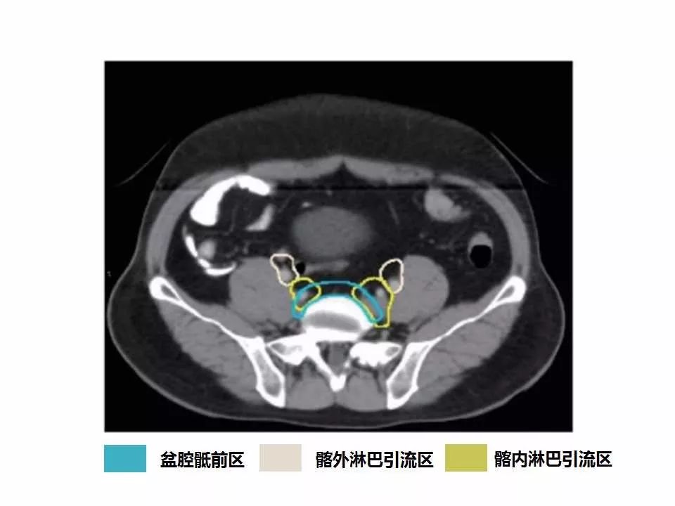 影像PPT - 直肠癌淋巴引流区图谱-11