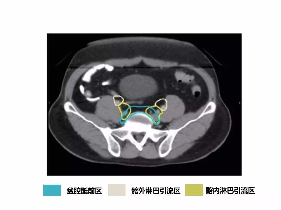影像PPT - 直肠癌淋巴引流区图谱-12