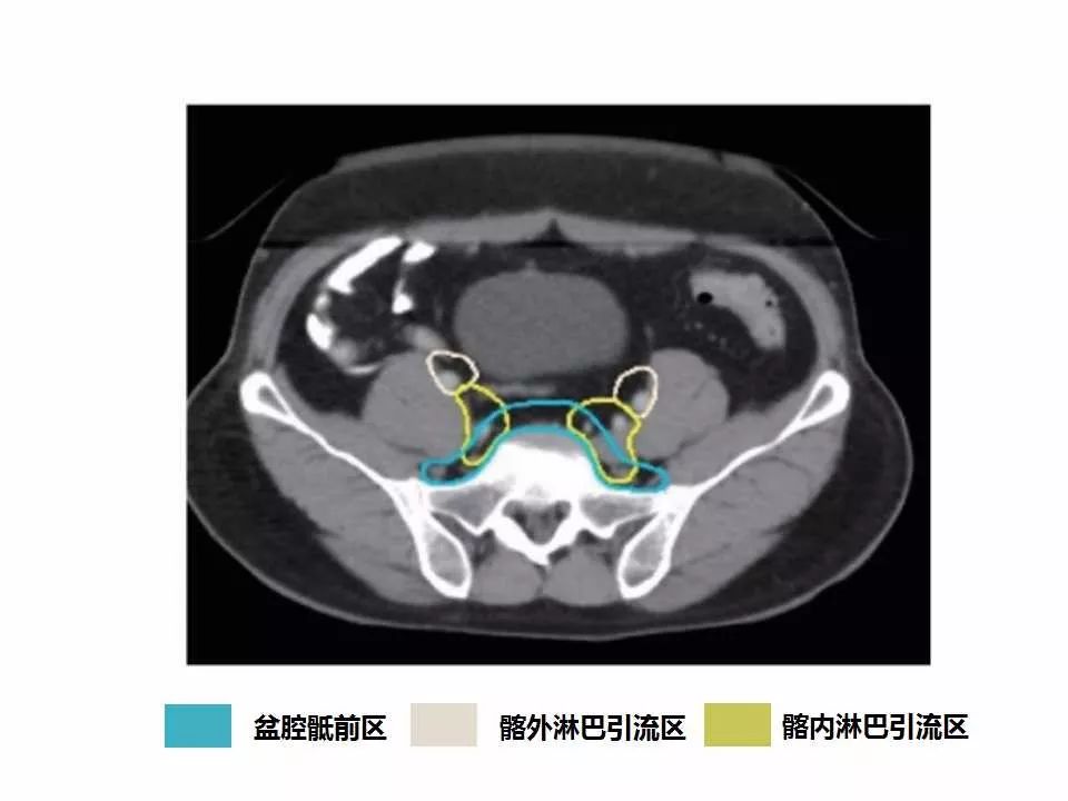 影像PPT - 直肠癌淋巴引流区图谱-13