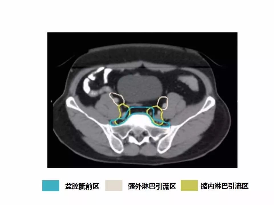 影像PPT - 直肠癌淋巴引流区图谱-14