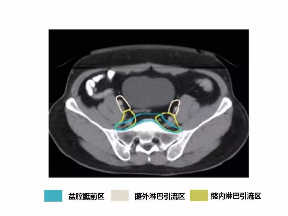 影像PPT - 直肠癌淋巴引流区图谱-15