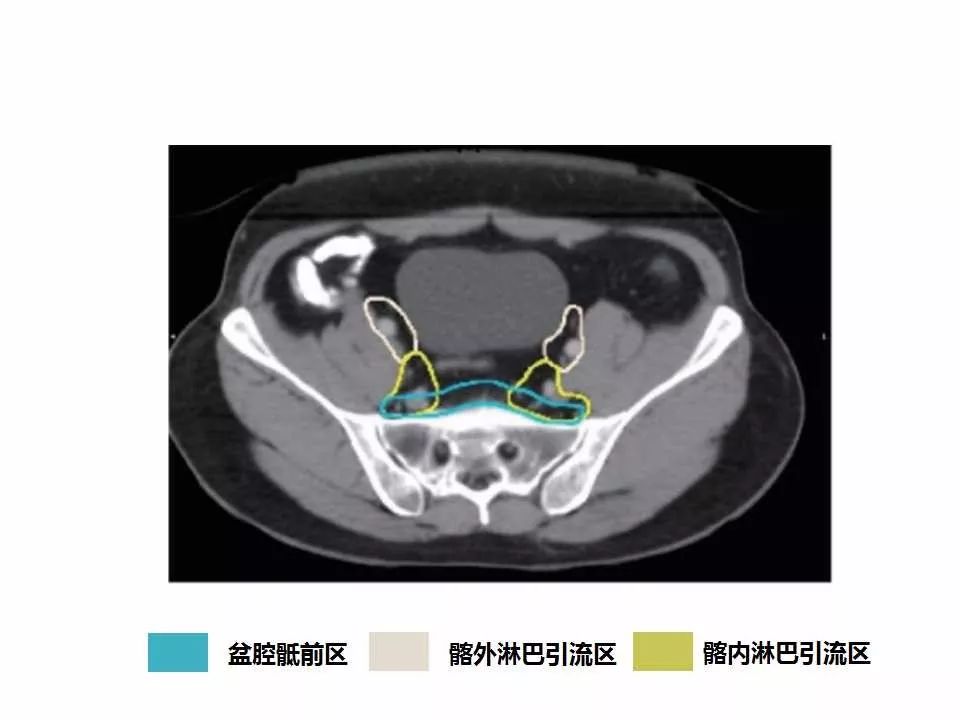 影像PPT - 直肠癌淋巴引流区图谱-16