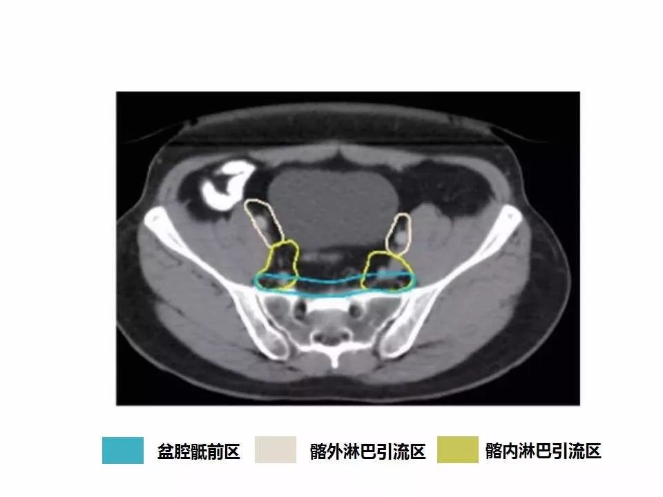 影像PPT - 直肠癌淋巴引流区图谱-17