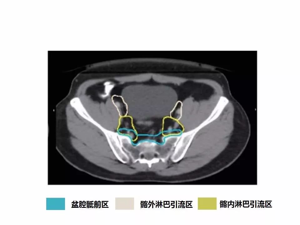 影像PPT - 直肠癌淋巴引流区图谱-18
