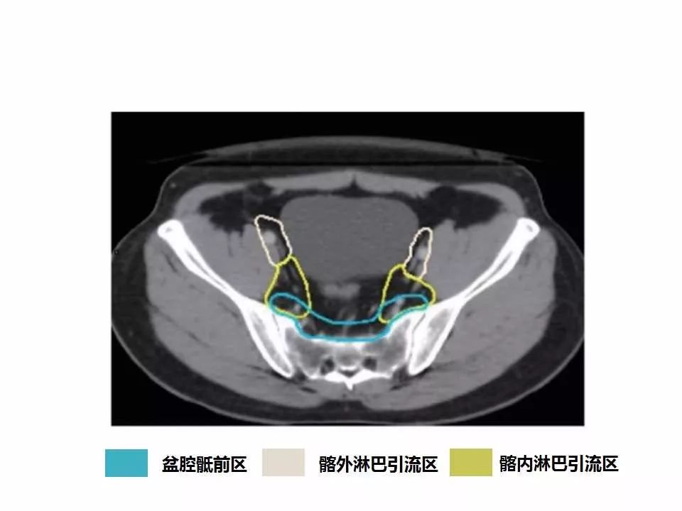 影像PPT - 直肠癌淋巴引流区图谱-19
