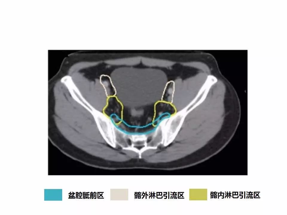 影像PPT - 直肠癌淋巴引流区图谱-20
