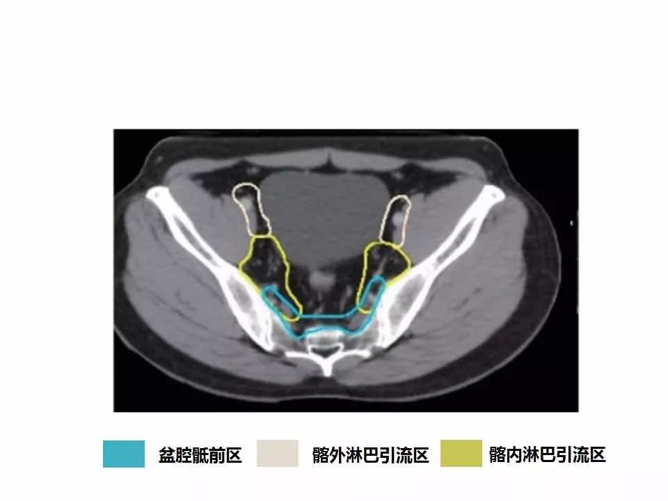 影像PPT - 直肠癌淋巴引流区图谱-21