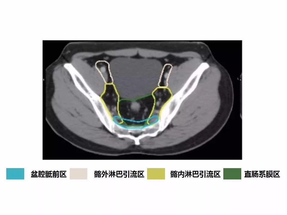 影像PPT - 直肠癌淋巴引流区图谱-22